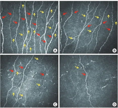 Fig. 1. Corneal confocal microscopy images  of the subbasal nerve plexus from a control  subject (A) and patients with mild (B),  mod-erate (C), and severe (D) diabetic  neuropa-thy demonstrating a progressive reduction  in corneal nerve fibers (red arrows