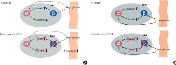 Fig. 1. Intra-islet insulin &amp; glucagon secretion. Normal (in nondiabetes) and advanced type 2 diabetes (T2D) of the relationship  between the inhibitory effects of pancreatic β-cell insulin secretion on pancreatic α-cell glucagon secretion