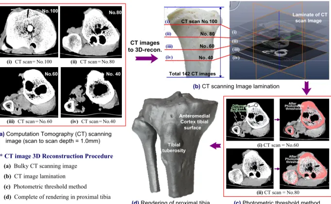 Fig. 4 Illustration of 3-dimensional CT image reconstruction on proximal tibia using computer assisted surgeries등(11)은 Aescula®금속판을 이용하여OWHTO 와 전방십자인대재건술(ACL recon.)의 동시수술 상호영 향성 연구에서 동시수술 시에도 하지 정렬의 회복과 PSA( 유지가 가능하였고 주요 합병증이 거),의 없는 안전한 술식이라고 보고한 바 있다 본