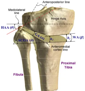 Fig. 10 (a) Three K-wires were inserted through the transverse line on the anteromedial surface of tibia, (b) Osteotomy gap was spread with speader