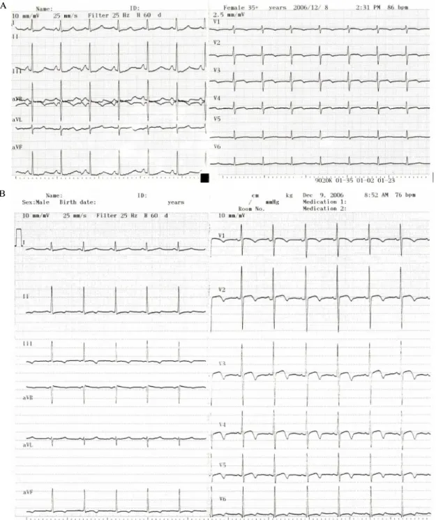 Fig.  1.   Electrocardiograms  showing  nonspecific  ST-T-wave  abnormalities.  A,  T-wave  inversion  in  leads  V 1 -V 4   at  presentation;  B,  ST-segment  elevation  in  leads  V 2 -V 4   and  T-wave  inversion  in  leads  Ⅱ,  Ⅲ,  aVF,  V 1 -V 6   on 