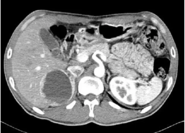 Fig.  1.   Abdominal  USG  shows  58  ×  59  mm  sized  mass  in  the  right  suprarenal  area.