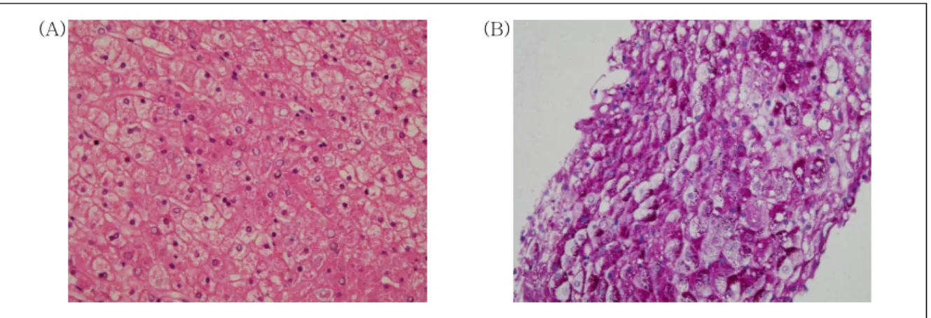 Fig. 3. Histology of liver biopsy. (A) swollen cytoplasm with intracytoplasmic vesicles and prominent cell border, forming a mosaic pattern (hematoxylin and eosin stain, × 400)