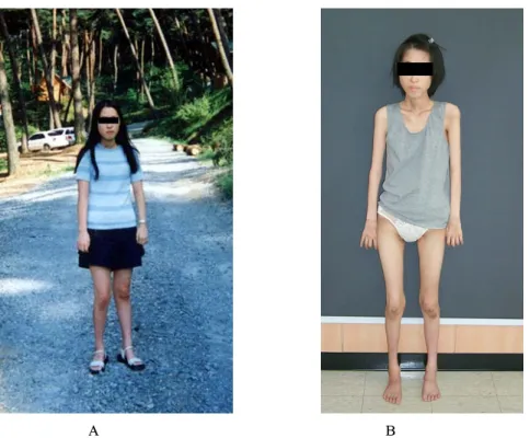 Fig.  2.  Pes  cavus  deformity  with  hammer  toe.