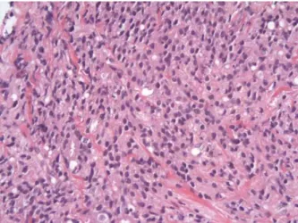 Fig. 1. Pathologic finding of prostate biopsy. Prostatic tissue shows poorly differentiated adenocarcinoma (H &amp; E, 400)