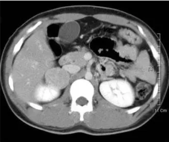 Fig. 1. Abdominal computed tomography (CT) of case 1. A) Abdominal CT performed at the age of 18 years.