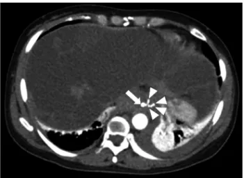 Fig. 2. Esophagogastroduodenoscopy. External compression is no- no-ted at the lower body, antrum, and duodenal bulb (arrowheads).