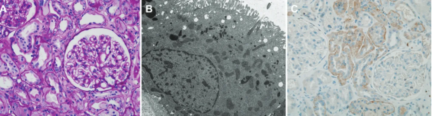 Fig. 1. Kidney biopsy findings. A: Light microscopy shows normal glomerular and tubulointerstitial architectures
