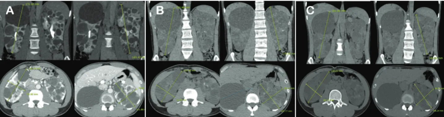 Fig. 1. Abdominal computed tomography at January 2015, April 2017, and April 2018. A) Right kidney: length, 171.30 mm; 