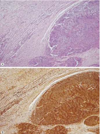Fig. 1. Enhanced chest computed tomography. A hyper-attenua- hyper-attenua-ted solid enhancing nodule can be seen in the right lower  parat-racheal area (arrow)