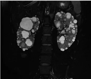 Fig. 1. Magnetic resonance imaging of the renal artery revealed innumerable cysts, causing diffuse enlargement of both kidneys