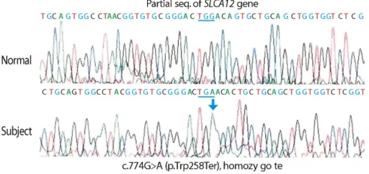 Fig. 3. SLC22A12 genotyping. Electropherograms of partial sequences of exon 4 of SLC22A12 showing the homozygous mutation c.774 G>A (p.Trp258Ter), or W258X, in the patient