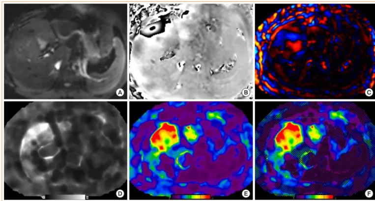 Fig. 3. Hepatic magnetic resonance elastography (MRE). Liver MRE study in a patient with nonalcoholic fatty liver disease showing: (A)  magnitude image, (B) phase contrast, (C) wave image, (D, E) gray and color scale stiffness maps (elastograms), and (F) c