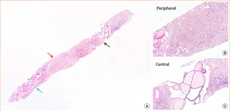 Fig. 1. Orientation of the thyroid core needle biopsy. (A) Normal thyroid tissue is noted on the left lower corner (blue arrow)