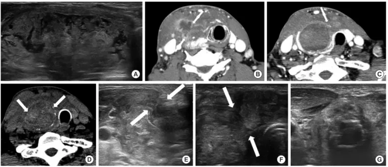 Fig. 2. (A) A 24-year-old woman, who presented with a bulging neck mass, had been treated with radiofrequency ablation (RFA) due to a  predominantly solid thyroid nodule at right thyroid gland