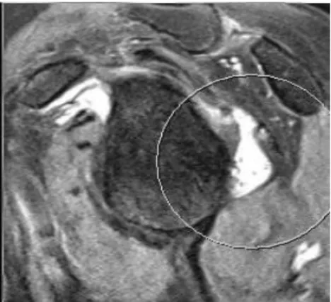 Figure  2.  Shoulder  MRI  of  Case  1 (small  capsular  taer,  post  aspect)