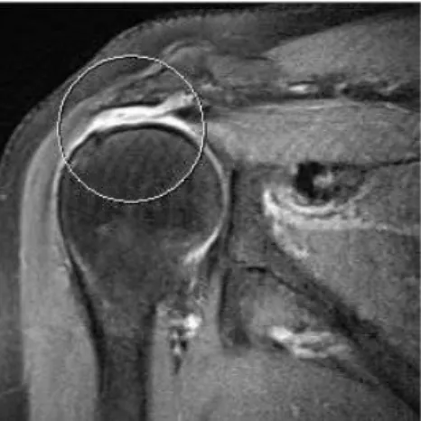 Figure  9.  Shoulder  MRI  of  Case  2