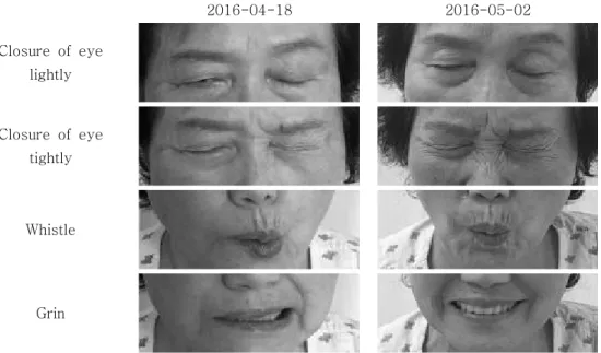 Fig. 2. Movement of orbicularis oculi &amp; orbicular muscle of mouth after 1 week and 3 weeks.