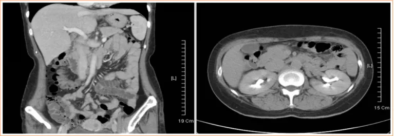 Fig. 1. Abdominal computed tomography findings of the small intestine showed no bowel wall edema or fluid collection.