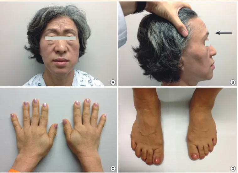 Fig. 1. (A) Physical examination of the patient revealed frontal bossing, thickened lips, and an enlarged nose