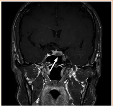 Fig. 2. A T1-weighted coronal magnetic resonance imaging of the  sella turcica indicated a 10×6-mm hypointense, nonenhanced  pi-tuitary adenoma on the left side of the pipi-tuitary gland (arrow).