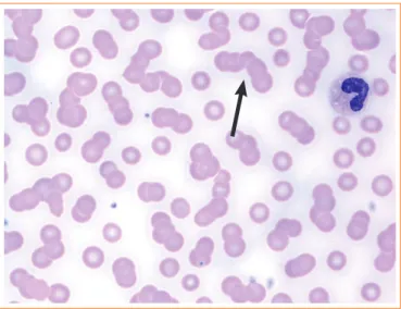 Fig. 3. Peripheral blood smear results revealed a red blood cell  rouleaux formation (arrow; Wright stain, ×1,000).