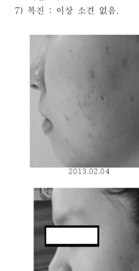 Fig  1.  Before  Treatment  (A)  and  After  Treatment  (B)