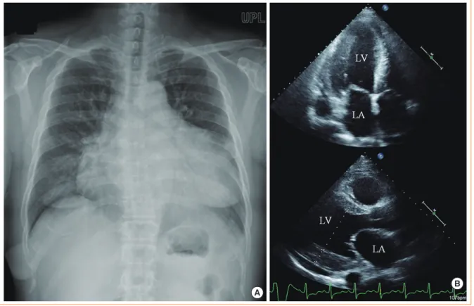 Fig. 1. Chest X-ray and echocardiogram findings showed marked cardiomegaly and left ventricle (LV) hypertrophy