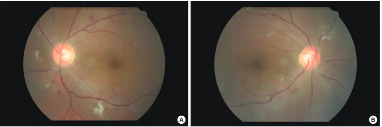 Fig. 4. (A, B) Fundoscopic findings showed cotton wool patches and hemorrhage on both retinae.