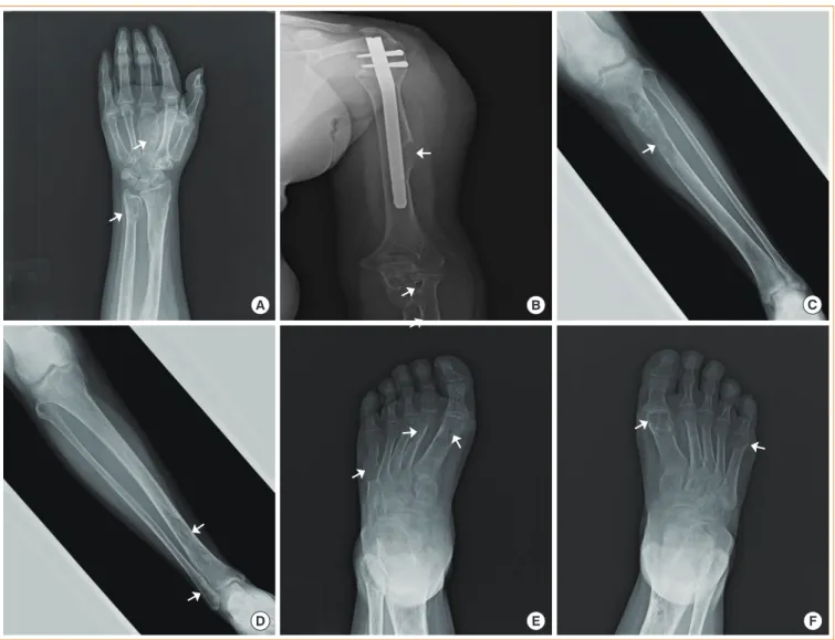 Fig. 2. Plain digital radiograph of the affected left wrist and hand (A), humerus (B), both tibia (C, left tibia; D, right tibia) and foot (E,  left foot; F, right foot) revealed multiple bony osteolytic expansile lesions (arrows) with cortical thinning, d