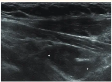 Fig. 3. Skull X-ray showed a granular “salt and pepper” appear- appear-ance, which is thought to be a typical finding of primary  hyper-parathyroidism