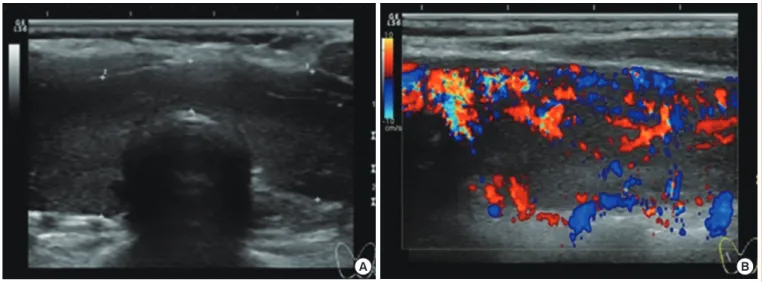Fig. 1. Thyroid ultrasonography showed mild enlargement of both thyroid lobes with heterogenous echogenicity (A) and increased vas- vas-cularity (B).