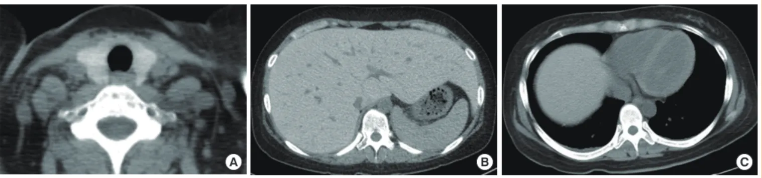 Fig. 1. Nonenhanced computed tomography scan revealed the high intensity of (A) the thyroid gland, (B) liver parenchyma with dilated  inferior vena cava and intrahepatic vain, and (C) myocardium.
