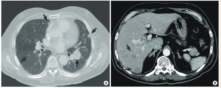 Fig. 1. Computed tomography of chest and abdomen showed (A) multiple pulmonary metastatic nodules (arrows) and (B) multiple he- he-patic lesions (arrows).