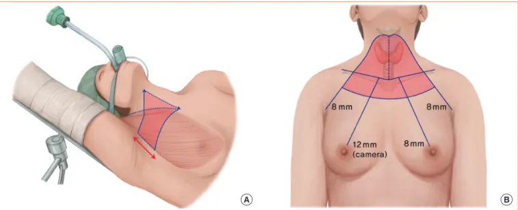 Table 1 shows the incidence of transient and permanent recur- recur-rent laryngeal nerve injury (RLNI) who underwent robotic or  OT