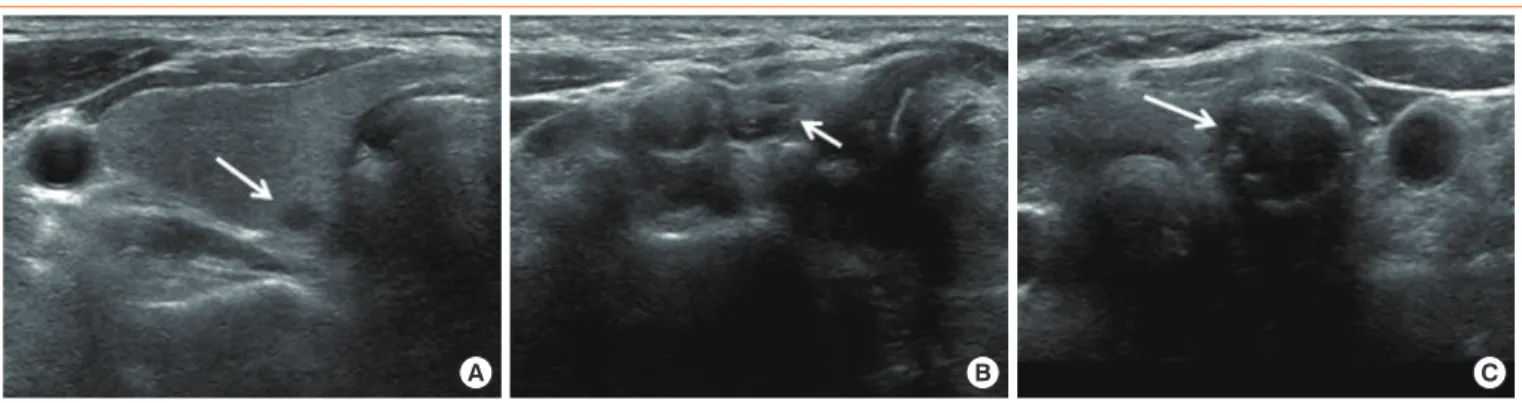 Fig. 2. An example of a potentially erroneous needle localization. (A) A bright echo (arrow) is visible in the ill-defined hypoechoic nod- nod-ule of the right thyroid lobe