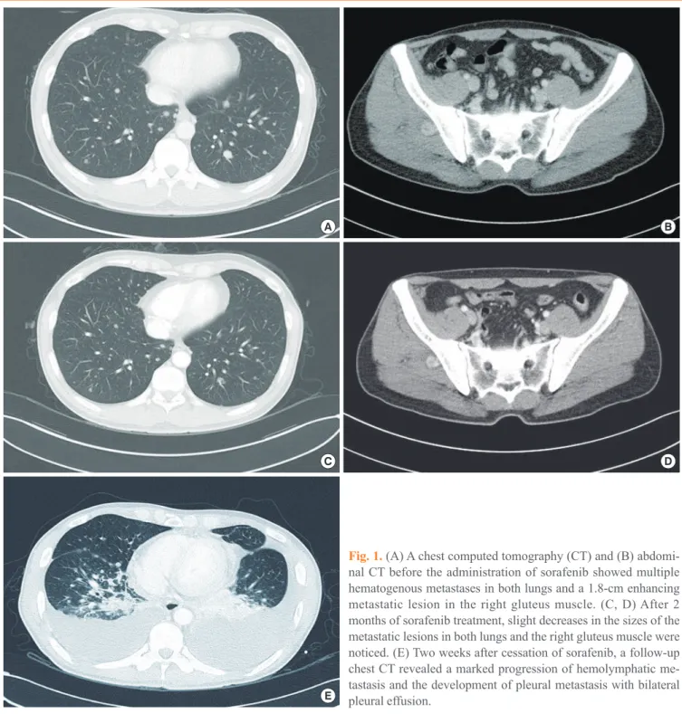 Fig. 1. (A) A chest computed tomography (CT) and (B) abdomi- abdomi-nal CT before the administration of sorafenib showed multiple  hematogenous metastases in both lungs and a 1.8-cm enhancing  metastatic lesion in the right gluteus muscle