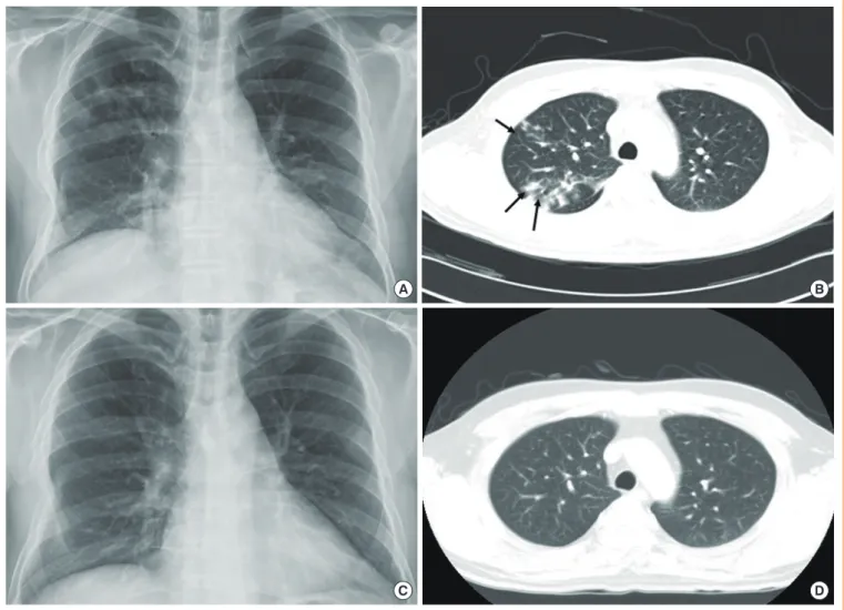 Fig. 3. (A) Chest X-ray and (B) computed tomography (CT) of chest with contrast enhancement revealed multiple patchy infiltrations  (black arrows) in both lung fields before chemotherapy