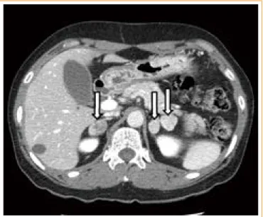 Fig. 1. Adrenal computed tomography (CT). Axial images from  noncontrast-enhanced adrenal CT show a right adrenal nodule   2.8 cm in diameter, and two left adrenal nodules, 2.3 and 1.7 cm,  respectively, in diameter (arrows).