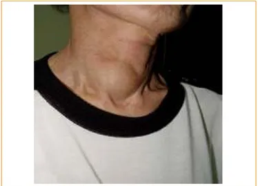 Fig. 1. Gross appearance of the neck. A very hard, fixed nodule is  seen in the right side of the neck