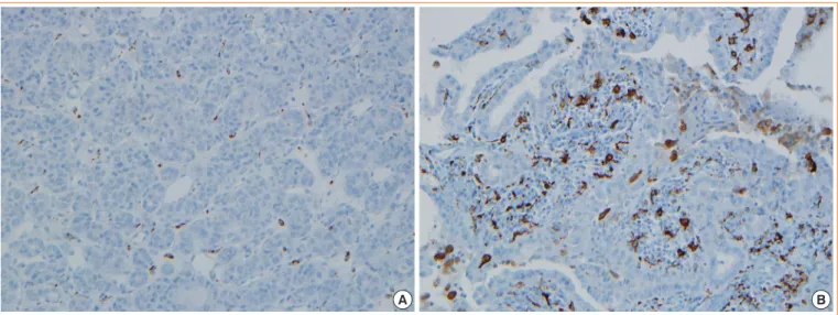 Fig. 1. Classification of the density of CD68-positive cells in human papillary thyroid carcinoma