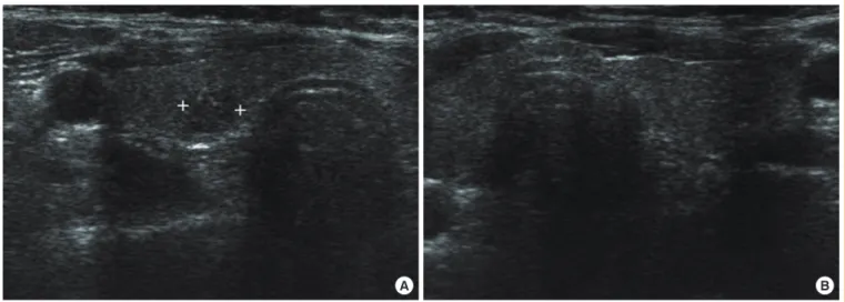 Fig. 1. Thyroid ultrasound before surgery. (A) Thyroid ultrasound shows an approximately 0.5×0.6-cm sized hypoechoic nodule in the  right thyroid