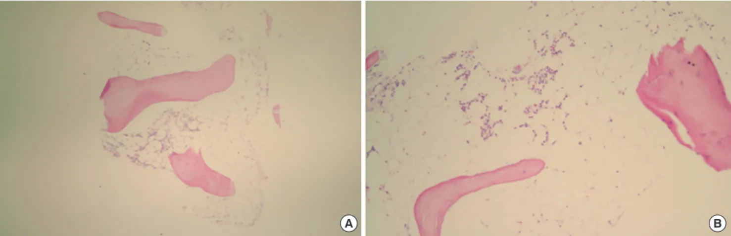 Fig. 1. Bone marrow biopsy section revealed decreased hematopoiesis with hypocellularity (A, H&amp;E stain,  × 40; B, H&amp;E stain,  × 100)