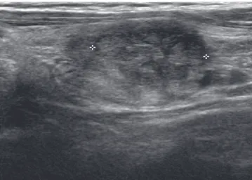 Fig. 3. Histology of the resected thyroid nodule. A. Histology demonstrates the papillary structure with ill defined margin (H&amp;E stain,  × 40, thyroid)