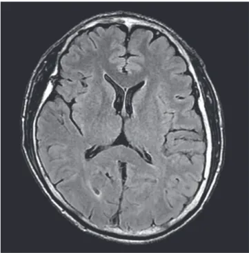 Fig. 1. Brain magnetic resonance imaging (MRI). Brain MRI shows no specific  finding. 