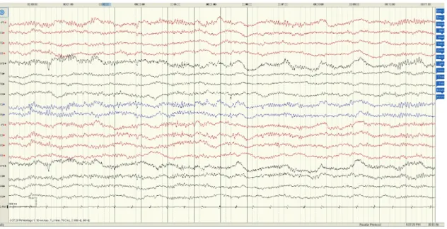Fig. 3. Waking electroencephalogram. Electroencephalogram shows normal waves and there are no epileptiform discharges or localizing signs.