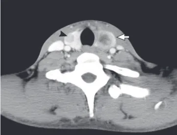 Fig. 1. Contrast-enhanced computed tomography scan of the neck demonstrat- demonstrat-ed a 2 cm sizdemonstrat-ed rim enhancing lesion with thick wall and necrotic portion at left  lobe of thyroid gland (arrow) and 10 mm sized nodule at right lobe of thyroi