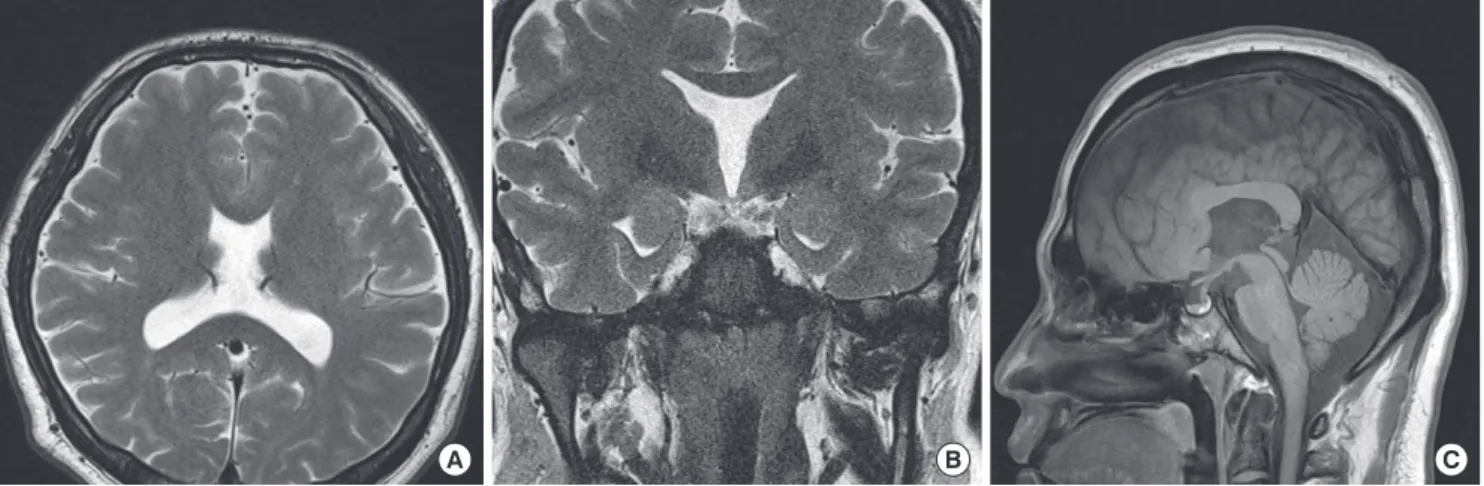 Fig. 1. (A) The sella MRI shows abnormal architecture of bilateral frontal horns of lateral ventricle