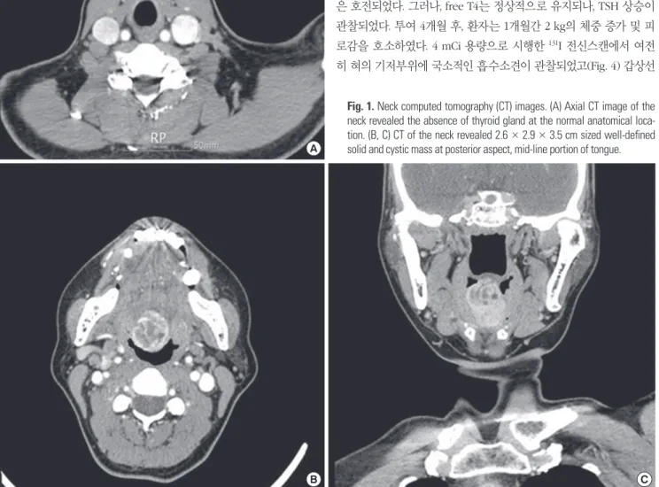 Fig. 1. Neck computed tomography (CT) images. (A) Axial CT image of the  neck revealed the absence of thyroid gland at the normal anatomical  loca-tion