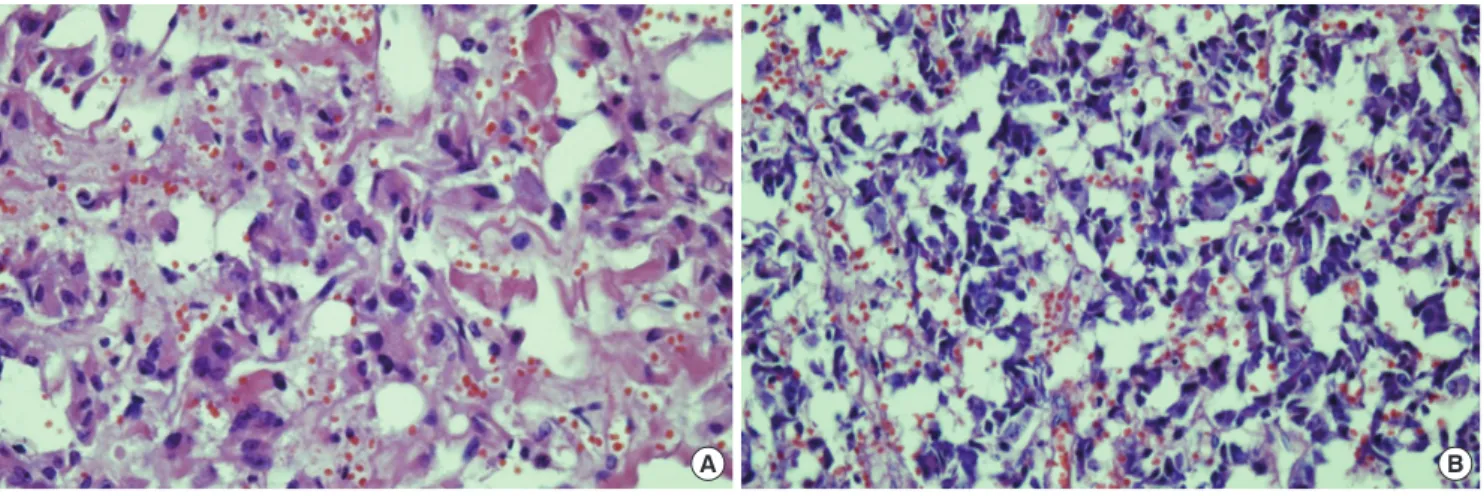 Fig. 4. Immunohistochemical staining of the right adrenal pheochromocytoma. The immunochemistry revealed positive reaction for neuron specific enolase (A, neu- neu-ron specific enolase stain,  ×  400) and synaptophysin (B, synaptophysin stain,  ×  400)